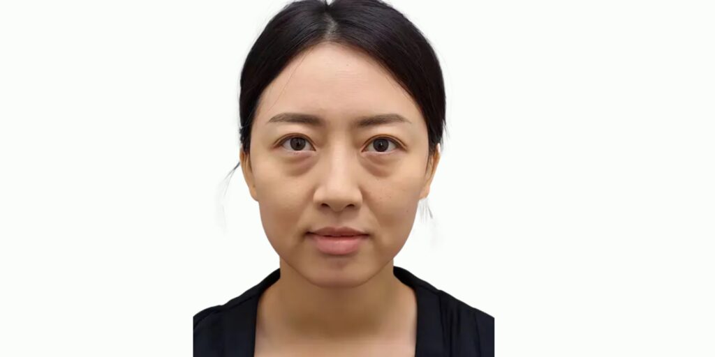 Đối tượng nên và không nên tiêm meso căng bóng (2)