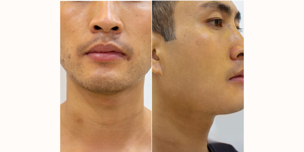 Triệt lông mặt vĩnh viễn cho nam giá bao nhiêu? Hướng dẫn chọn spa uy tín 8 Gợi ý địa chỉ spa triệt lông mặt uy tín cho nam tại TP. HCM (2)