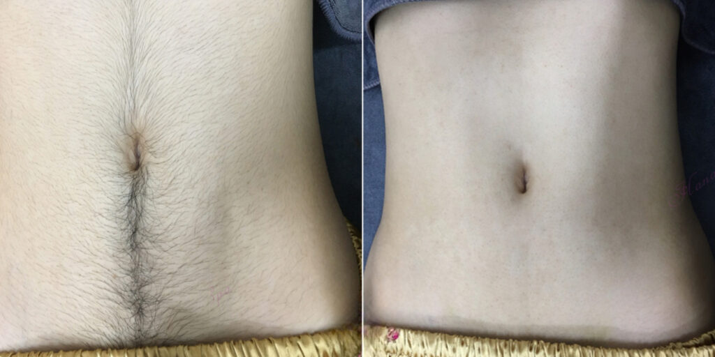 Giá triệt lông bụng bao nhiêu? Cập nhật bảng giá mới nhất 2025 11 Gợi ý địa chỉ triệt lông bụng uy tín và an toàn tại TP. HCM