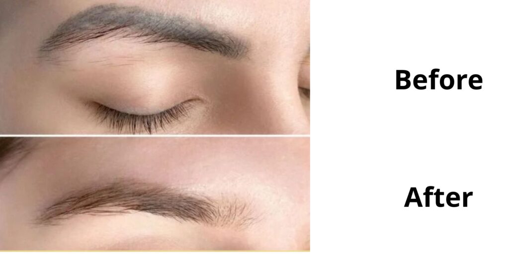 Giá triệt lông mày bao nhiêu? Bảng giá mới nhất 2025 11 Gợi ý địa chỉ triệt lông mày uy tín và an toàn tại TP. HCM (2)