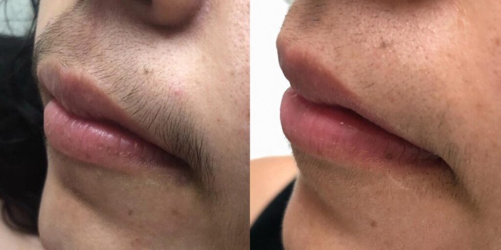 Triệt lông mép giá bao nhiêu? Gợi ý địa chỉ triệt lông uy tín tại TP. HCM 13 Gợi ý địa chỉ triệt lông mép uy tín tại TP. HCM