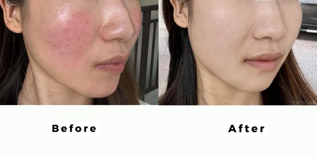 Hiệu quả và tác dụng của tiêm meso căng bóng da