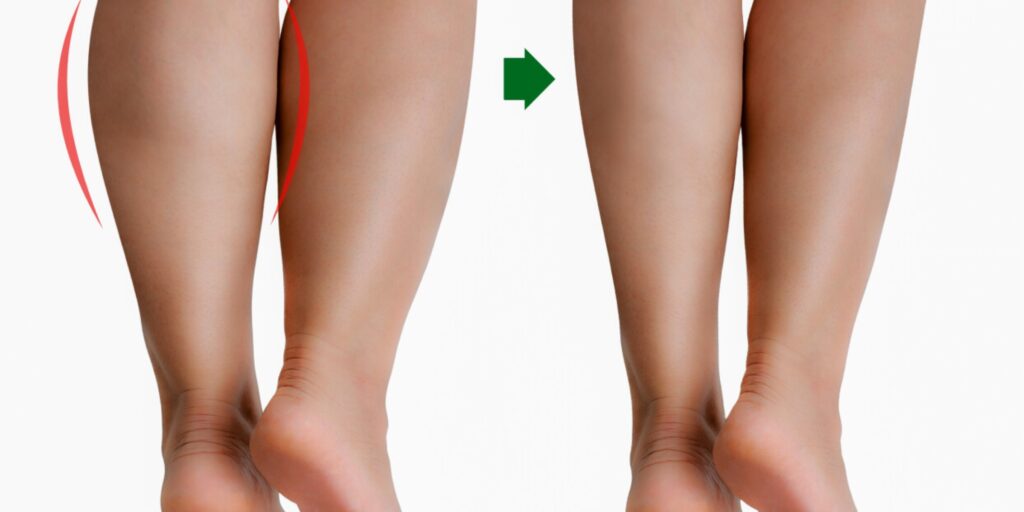 Tiêm botox thon gọn bắp chân giá bao nhiêu và hiệu quả bao lâu? 6 Hiệu quả và thời gian duy trì của tiêm botox bắp chân