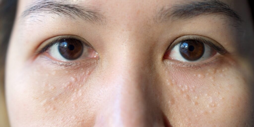 Trị mụn thịt bằng laser bao nhiêu tiền và có hiệu quả không? 2 Mụn thịt là gì Hiểu đúng về mụn thịt trước khi trị