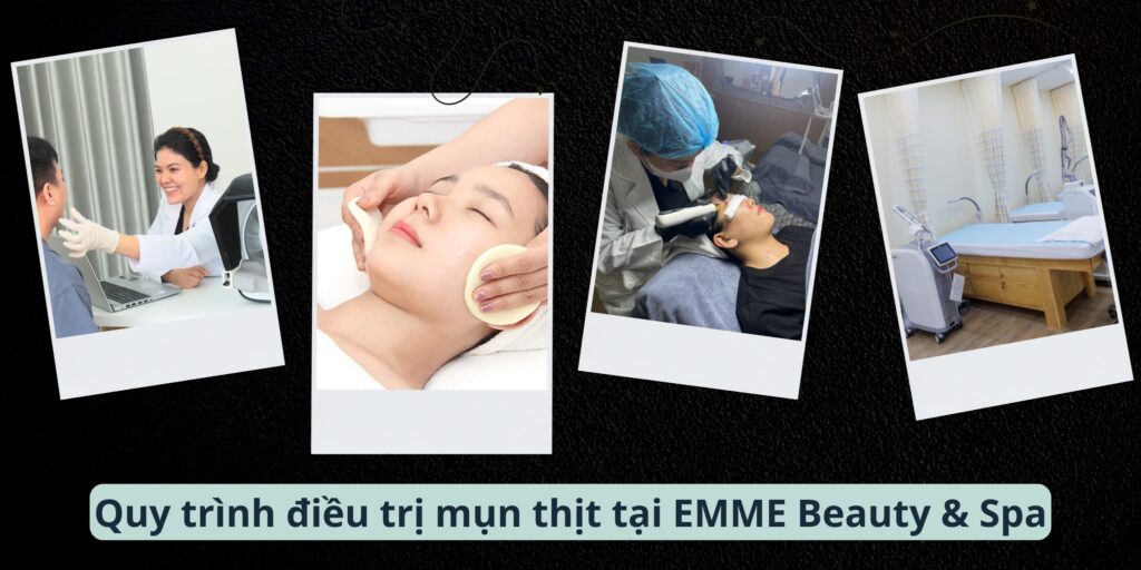 Trị mụn thịt bằng laser bao nhiêu tiền và có hiệu quả không? 4 Quy trình điều trị mụn thịt tại EMME Beauty & Spa