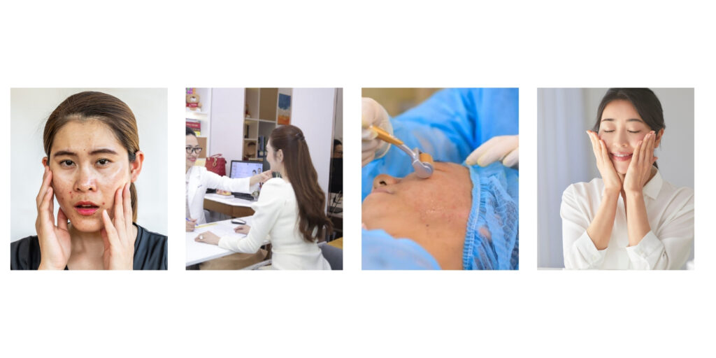 Điều trị mụn 3 Quy trình thăm khám & điều trị mụn tại Emme Beauty & Spa