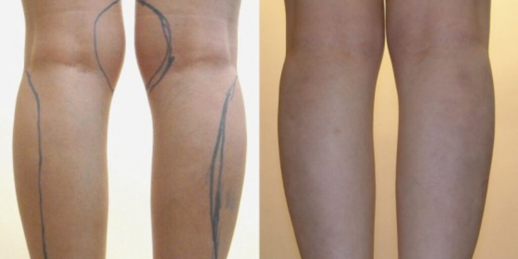 Tiêm botox thon gọn bắp chân giá bao nhiêu và hiệu quả bao lâu? 5 Quy trình thực hiện tiêm botox thon gọn bắp chân tại EMME Beauty & Spa