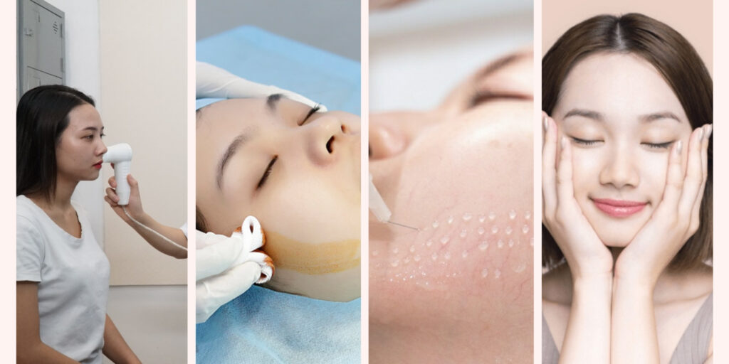 Quy trình tiêm meso căng bóng da tại EMME Beauty & Spa