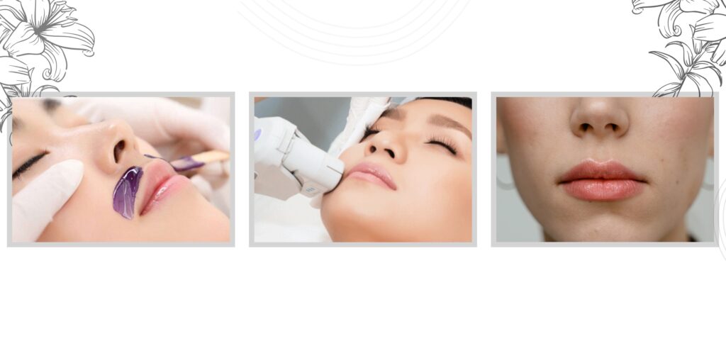 Triệt lông mép giá bao nhiêu? Gợi ý địa chỉ triệt lông uy tín tại TP. HCM 12 Quy trình triệt lông mép chuẩn y khoa tại EMME Beauty & Spa