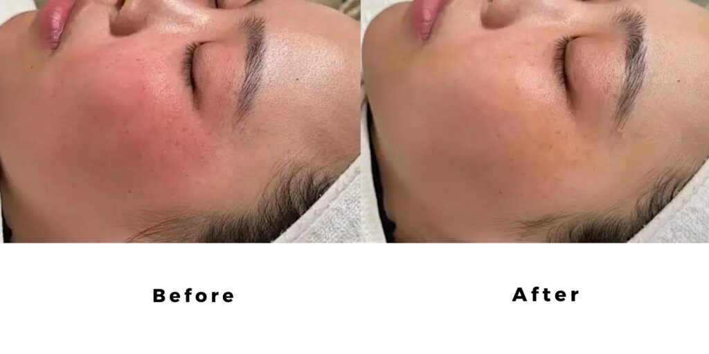 Tác dụng của tiêm meso phục hồi da