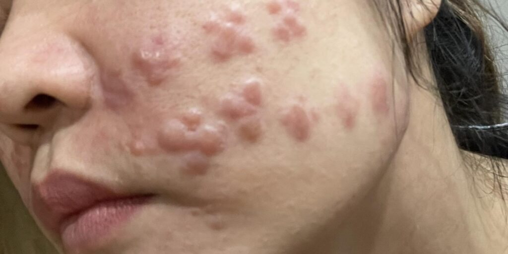 Tác dụng phụ và rủi ro của tiêm meso trị nám