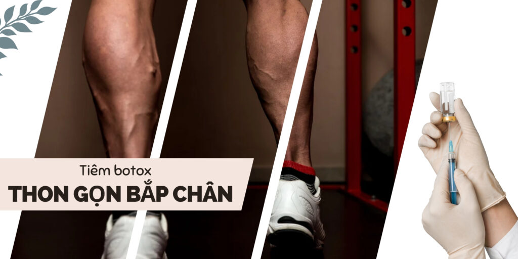 Tiêm botox bắp chân uy tín thumb