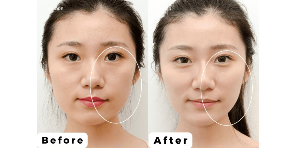 Tiêm botox căng da mặt giá bao nhiêu và hiệu quả ra sao? 3 Tiêm botox căng da mặt hiệu quả ra sao