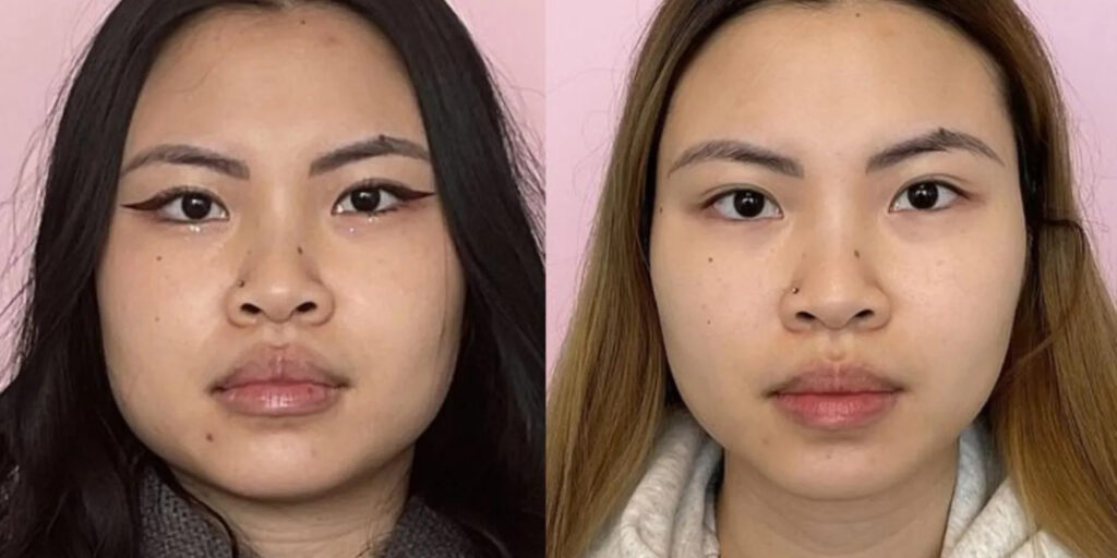 Tiêm botox gọn hàm giá bao nhiêu? Gợi ý địa điểm tiêm uy tín 2 Tiêm botox gọn hàm bao lâu thì thấy hiệu quả