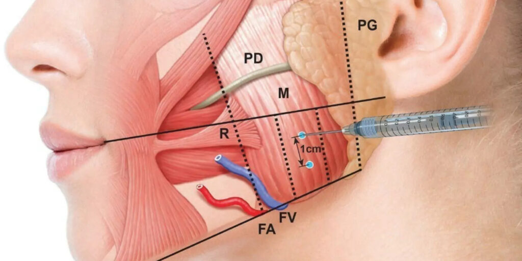 Tiêm botox gọn hàm giá bao nhiêu? Gợi ý địa điểm tiêm uy tín 3 Tiêm botox gọn hàm có đau và nguy hiểm không