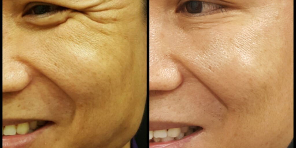 Tiêm botox xóa nhăn mắt giá bao nhiêu và hiệu quả ra sao? 4 Tiêm botox xóa nhăn mắt có gây nguy hiểm không