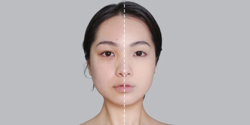 Tiêm meso bao lâu 1 lần thì hiệu quả