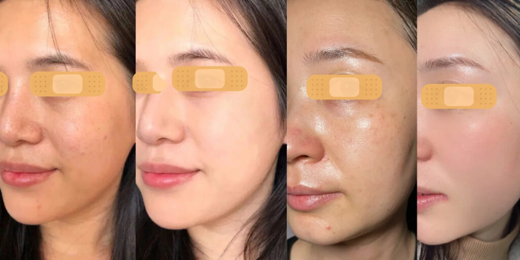 Tiêm meso căng bóng da giá bao nhiêu