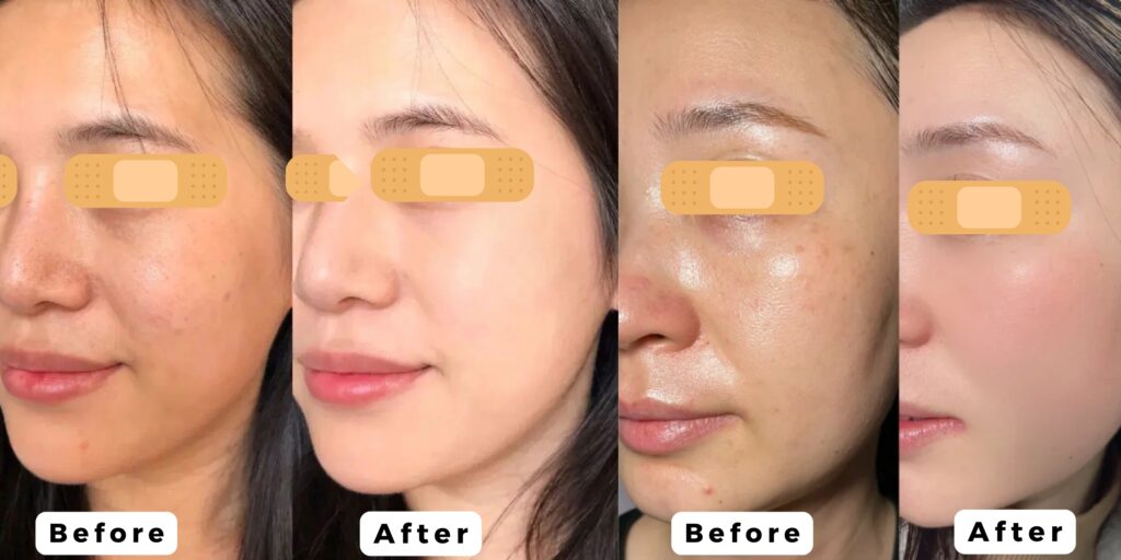 Tiêm meso có hiệu quả trong bao lâu