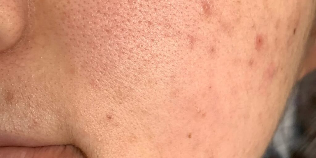 Tiêm meso phục hồi da là gì