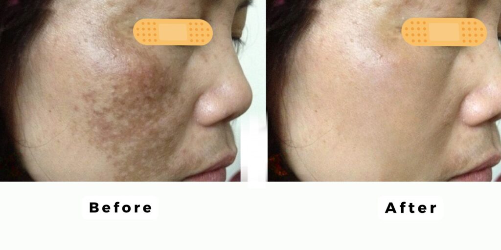 Tiêm meso trị nám có tốt không