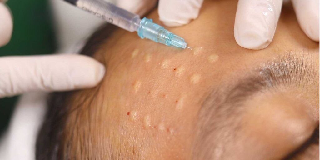 Tiêm meso trị nám là gì