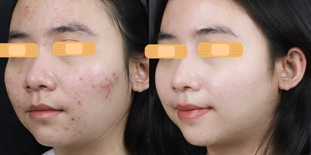 Tiêm meso trị thâm mụn có tác dụng gì