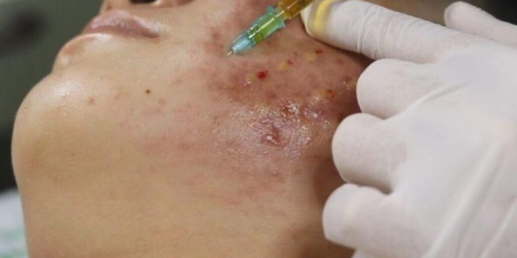 Tiêm meso trị thâm mụn là gì