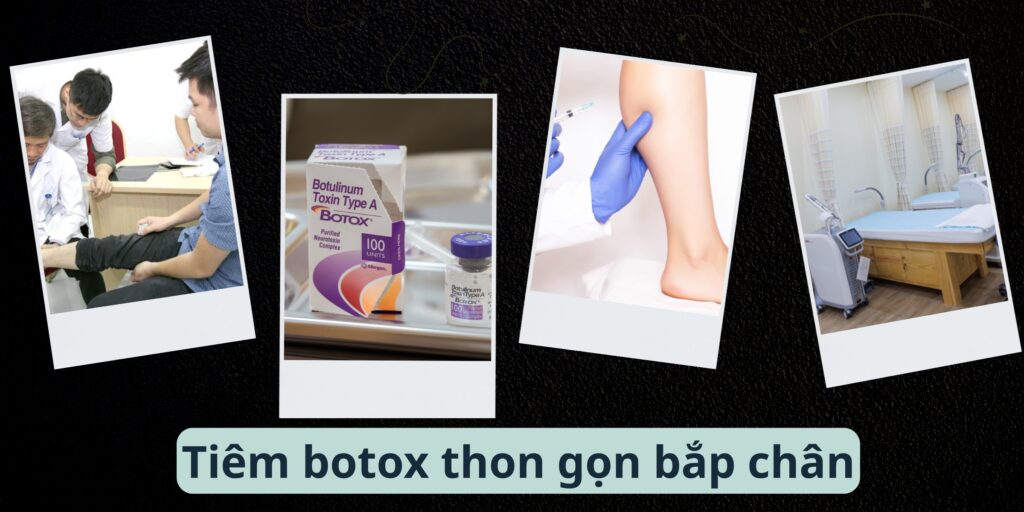 Tiêm botox thon gọn bắp chân giá bao nhiêu và hiệu quả bao lâu? 7 Tiêu chí lựa chọn cơ sở tiêm botox bắp chân uy tín