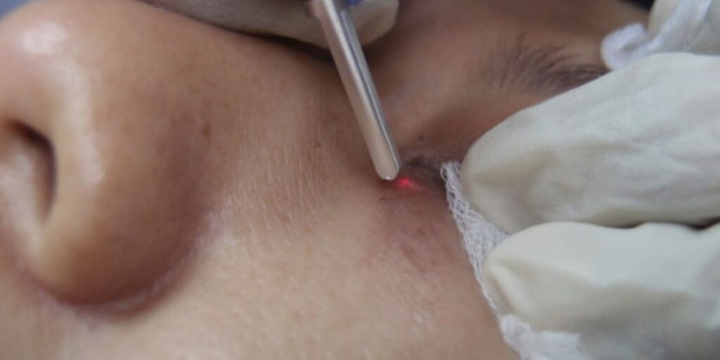 Trị mụn thịt bằng laser bao nhiêu tiền và có hiệu quả không? 3 Trị mụn thịt bằng laser là gì