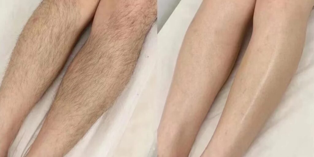 Triệt lông có hiệu quả trong bao lâu