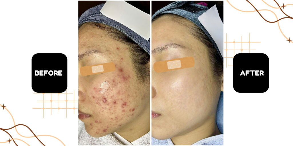 Điều trị mụn 4 Ưu điểm khi điều trị mụn tại Emme Beauty & Spa