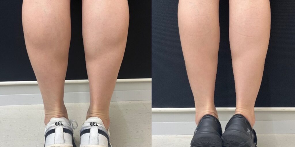 Tiêm botox thon gọn bắp chân giá bao nhiêu và hiệu quả bao lâu? 3 Ưu điểm và hạn chế của tiêm botox thon gọn bắp chân