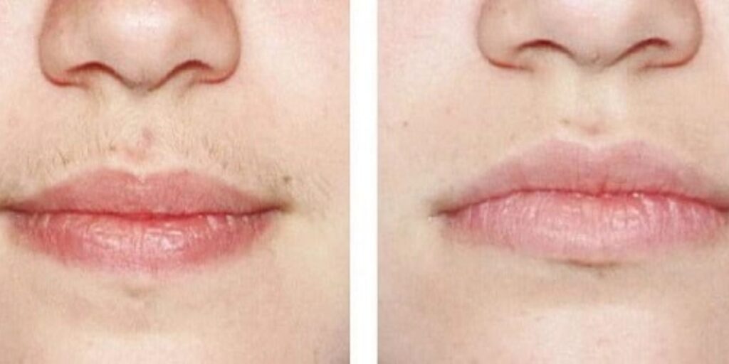 Triệt lông mép giá bao nhiêu? Gợi ý địa chỉ triệt lông uy tín tại TP. HCM 11 Ưu điểm và nhược điểm khi chọn triệt lông mép vĩnh viễn