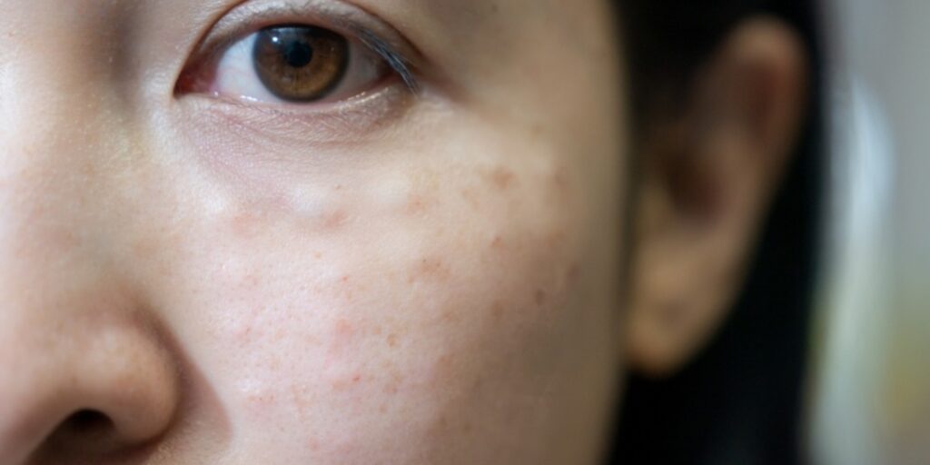 Ưu nhược điểm của tiêm meso vùng mắt