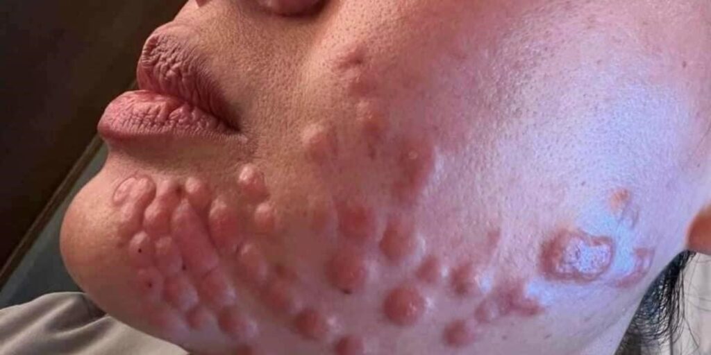 Ưu và nhược điểm có thể gặp khi tiêm meso