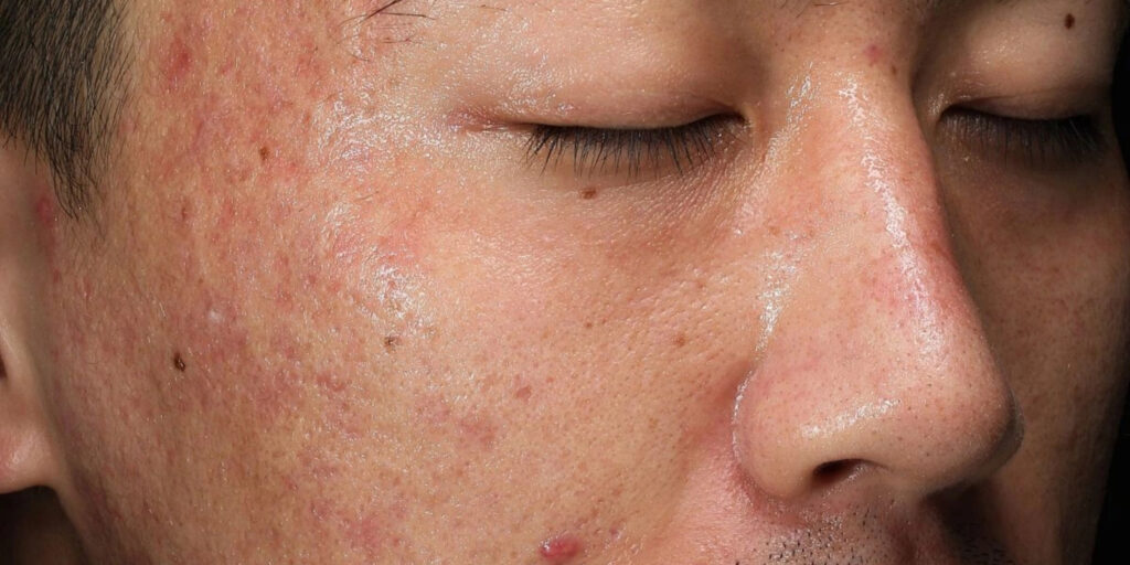 Vì sao nam giới nên đi trị mụn tại cơ sở uy tín thay vì tự trị tại nhà