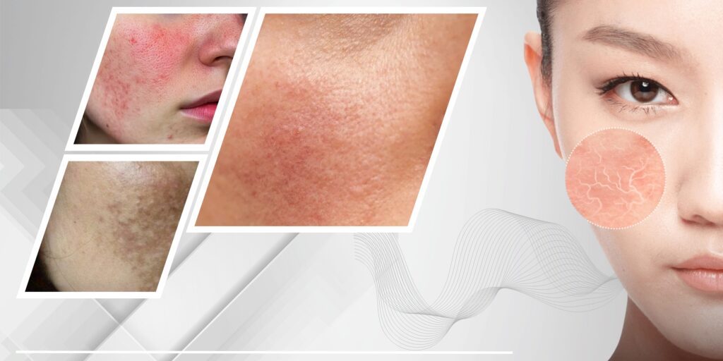 tiêm meso loại nào tốt thumb