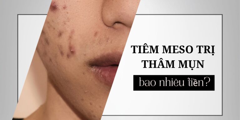 tiêm meso trị thâm mụn thumb